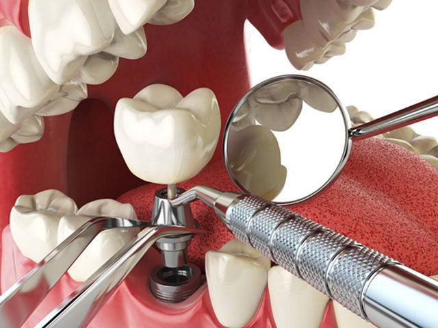 7نکته درباره ایمپلنت و کاشت دندان که باید بدانید